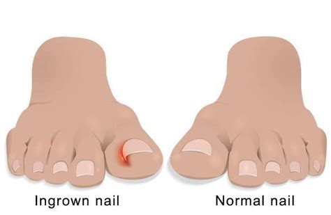 How To Treat An Ingrown Toenail North Star Foot And Ankle Associates