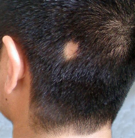 7 claves para saber qué es la alopecia areata Rueber Centro Capilar