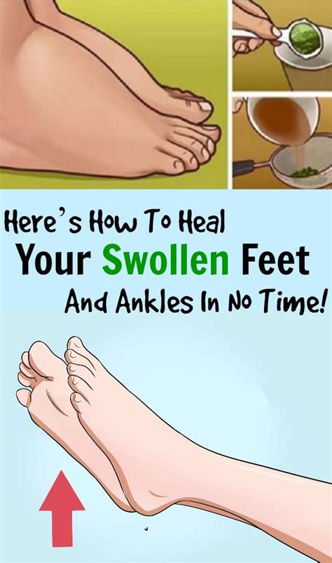 Swirlster First Stop Feet From Swelling