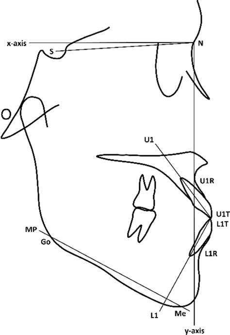 Landmarks And Reference Planes Used In The Cephalometric Analysis Download Scientific Diagram