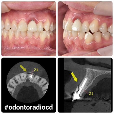 Espessamento Do Ligamento Periodontal