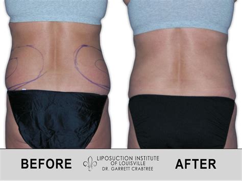 Female Love Handles Before After Gallery Liposuction Institute Of