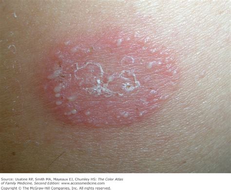 Tinea Corporis Causes