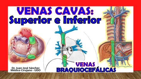 🥇 Vena Cava Superior E Inferior Anatomía Venas BraquiocefÁlicas