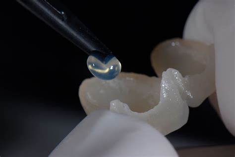 How to Solve Porcelain Chipping in a Full Arch Implant-Supported