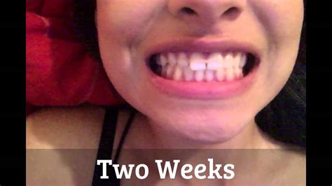 There's no exact time until teeth move, but it won´t happen in a day; Results of using goody hair bands to close gap tooth - YouTube