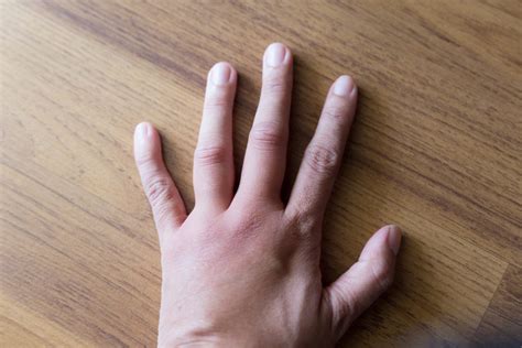 10 Reasons You Have Swollen Fingers Geelong Medical And Health Group