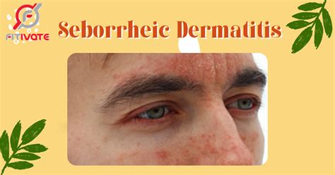 Yohumart No Adverse Reaction Psoriasis Balm Head Seborrheic Dermatitis Cream Repair Hair