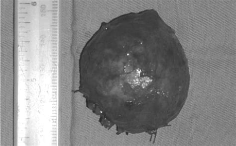 Gross Finding Of The Excised Tumor The Tumor Was Wellencapsulated By