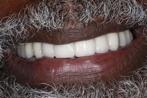 Full Mouth Reconstruction Dental Implants Fixed Bridges