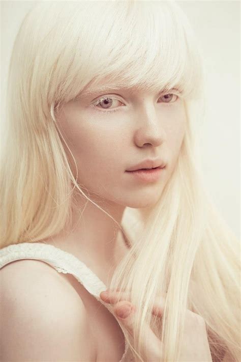 Nastya Kumarova Albino Girl Portrait Imperfection Photography