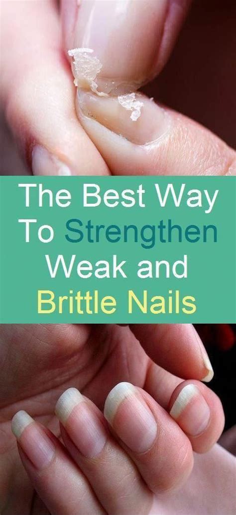 As we know, poor nutrition causes brittle hair, and it's very important to make healthy changes to your diet for healthy. What You Should Do About Hair Loss and Brittle Nails Treatment