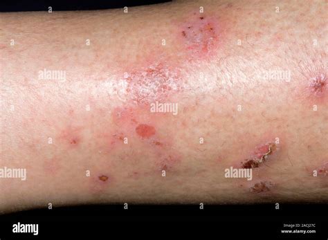 Close Up Of Vesicles And Scratch Marks On The Leg In A 57 Year Old