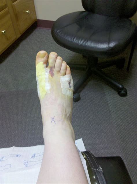 MoveMe: Bunions, Treatments, Surgeries...Oh My! The Story ...