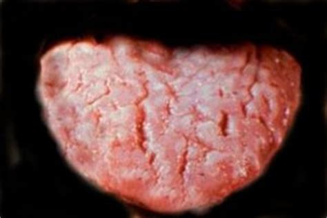 Nov 21, 2019 · fissured tongue does not usually cause additional symptoms in most people. Fissured Tongue 5 - Geographic Tongue | Healthy Tongue Secrets