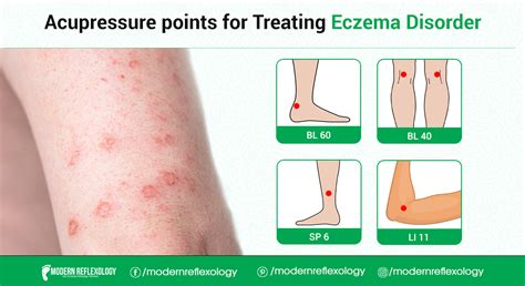Acupressure Points For Eczema Disorder Acupressure Points