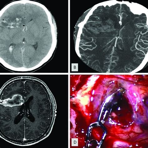 A Initial Noncontrast Head Computed Tomography Ct Showing Right