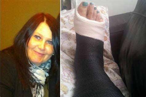 I Broke My Ankle But Was Too Fat To Use Crutches Liverpool Echo