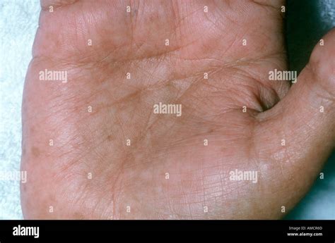 Addisons Disease Hyperpigmentation Pigment Hi Res Stock Photography And