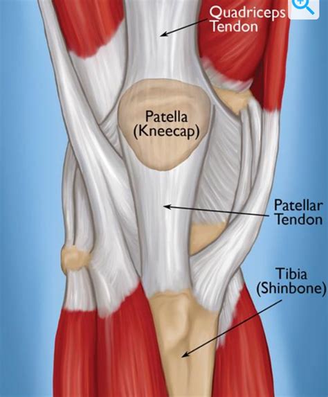 All About Patellar And Quadriceps Tendon Tears 321gomd