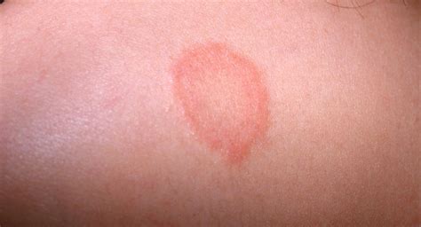 Ringworm In Babies And Children Babycenter