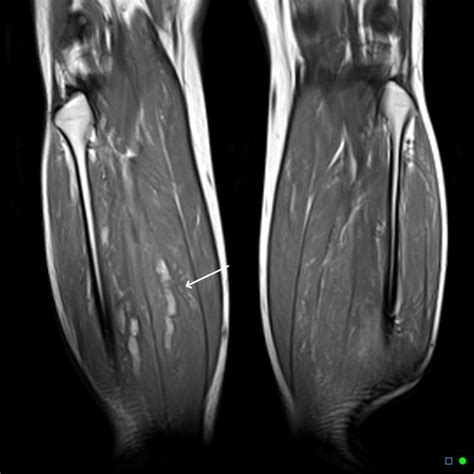 The calf muscles consist of the larger gastrocnemius muscle and the soleus muscle which is located deeper and lower down the leg. Muscle oedema secondary to calf DVT on MRI | Image ...