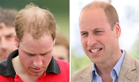 Prince William Has Never Had Hair Transplant Despite Thinning Hair