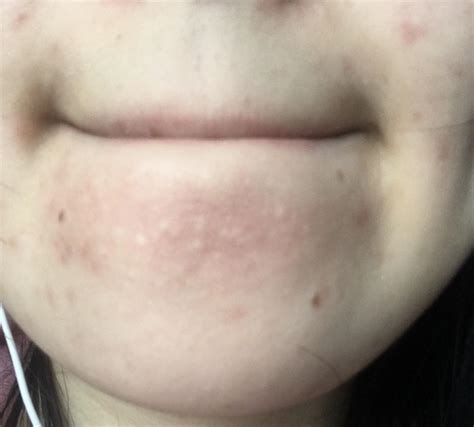 Skin Concerns White Visible Bumps On Chin I Think They Are Huge
