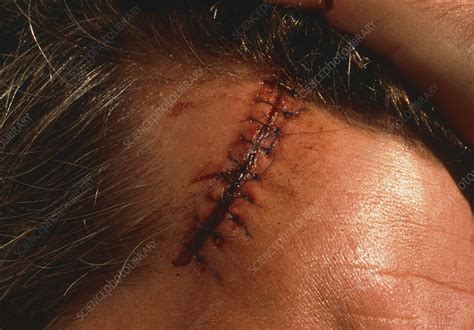 View Of A Sutured Laceration On A Mans Scalp Stock Image M3300779