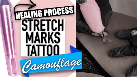 Dec 20, 2020 · find the latest breaking news and information on the top stories, politics, business, entertainment, government, economy, health and more. Scar Camouflage Tattoo Before and After, Stretch marks ...