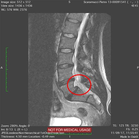 Roberto Bristot Chirurgia Vertebrale Maggiore Neurochirurgia Colonna