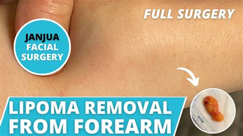 Large Lipoma Removal From Womans Forearm Dr Tanveer Janjua New