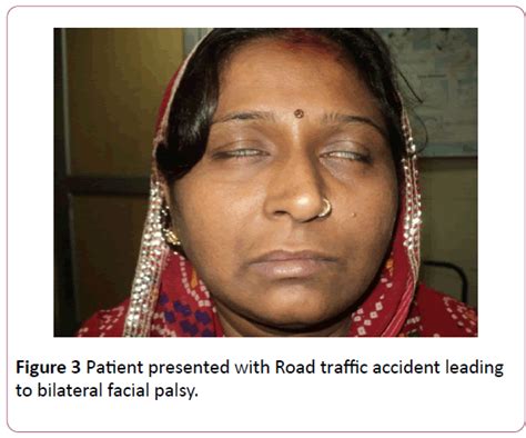 Simultaneous Bilateral Facial Nerve Palsy Case Series And Review