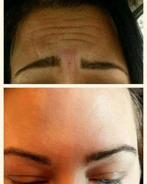 Botox Before And After Pics Forehead 11 Facelift Info Prices