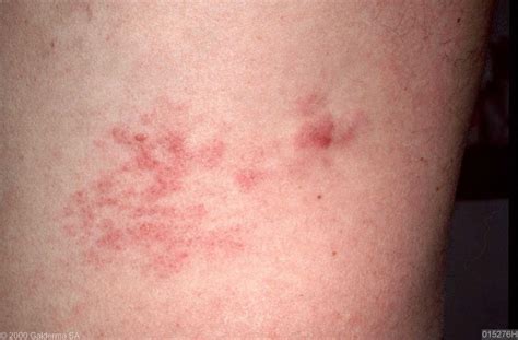 Cutaneous T Cell Lymphoma Rash Early Stage