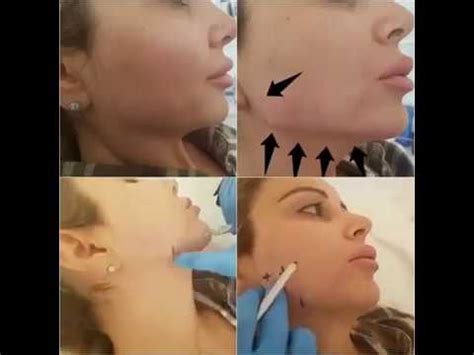 The results are natural and those around you may think that you. Jawline Botox - Before & After - YouTube