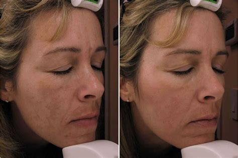 Common Treatment For Hyperpigmentation Justinboey