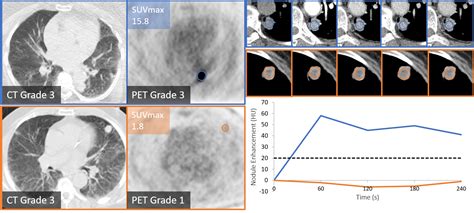 Dynamic Contrast Enhanced CT Or PET CT For Diagnosis Of Solitary Pulmonary Nodules ECR Today