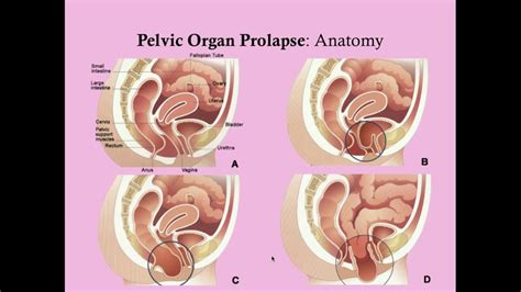 Pelvic Organ Prolapse Crash Medical Review Series Youtube Free