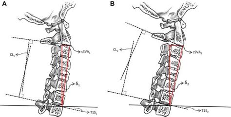 A New Piece Of The Puzzle To Understand Cervical Sagittal Alignment