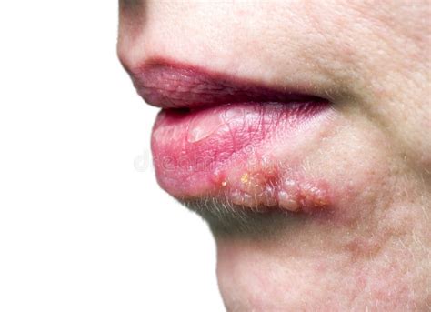 Herpes On The Lip Stock Image Image Of Disease Face 141152267