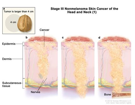 Skin Cancer Vanderbilt Ingram Cancer Center