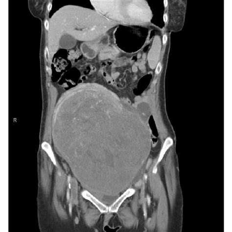 Abdomen Pelvis CT Scan Of Case 2 Showing Large Uterine Leiomyoma