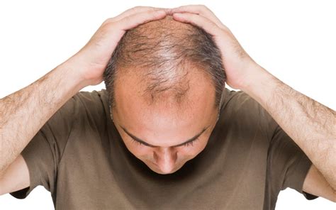 What Causes Male Pattern Baldness Superliving
