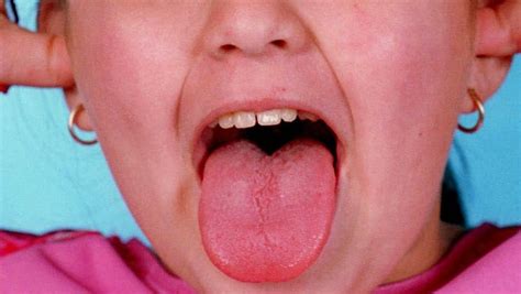 Girl 8 Gets Tongue Stuck In Glass Drink Bottle The Courier Mail