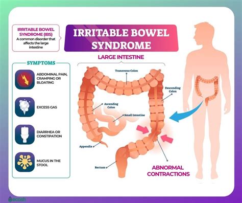 Irritable Bowel Syndrome Ibs Symptoms Causes Risk Groups Home Remedies For Ibs Natural