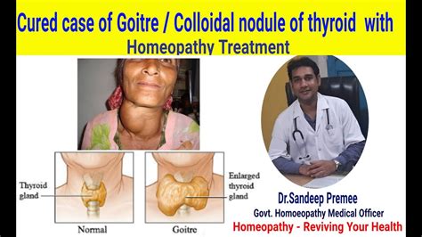 Goitre Homeopathic Tretment Goitre Colloidal Nodule Of Thyroid