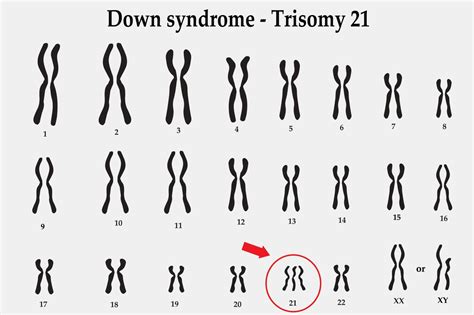 Trisomy The Obg Project