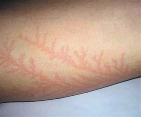 Initial symptoms may include heart asystole and respiratory arrest. People hit by lightning reveal their scars and it looks really weird