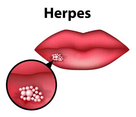 herpes en el labio infografía ejemplo del vector en fondo aislado ilustración del vector